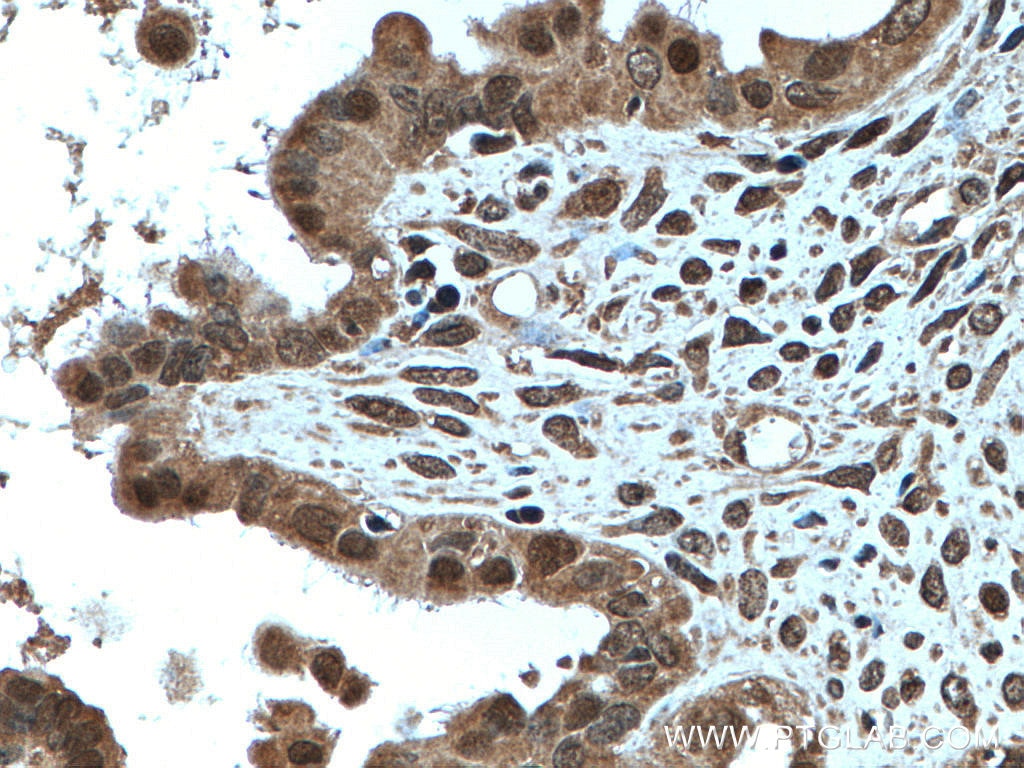 Immunohistochemistry (IHC) staining of human ovary tumor tissue using EGR1 Polyclonal antibody (22008-1-AP)