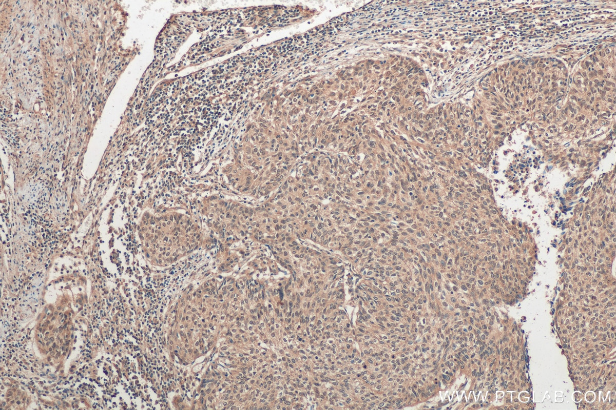 Immunohistochemistry (IHC) staining of human cervical cancer tissue using EGR1 Polyclonal antibody (55117-1-AP)