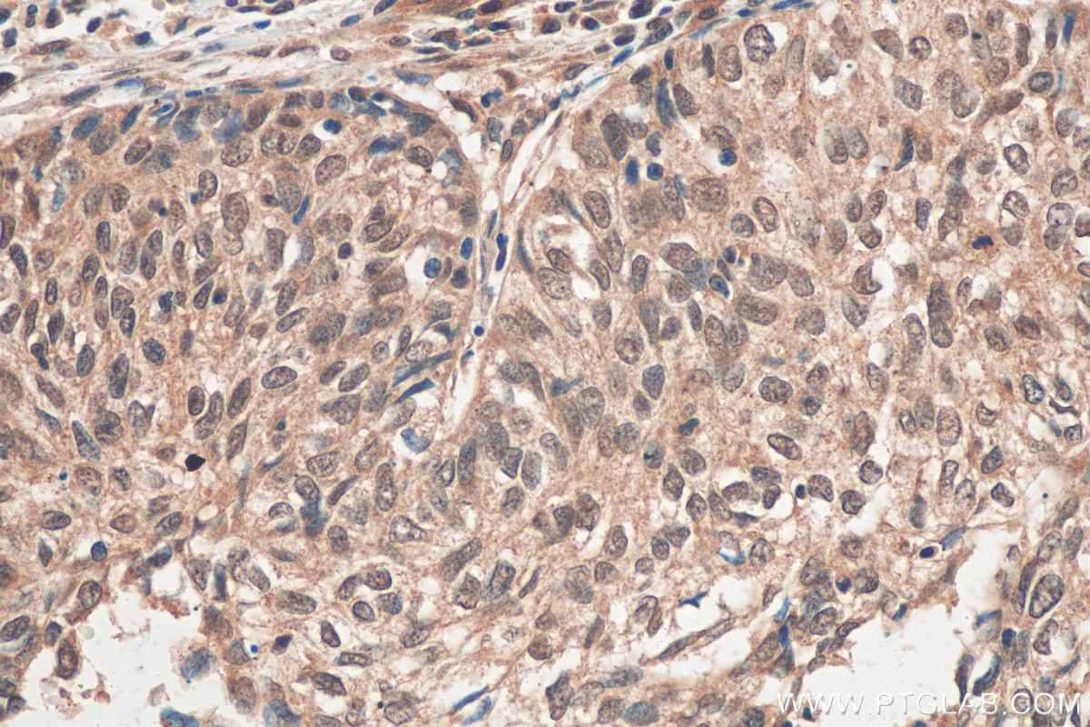 Immunohistochemistry (IHC) staining of human cervical cancer tissue using EGR1 Polyclonal antibody (55117-1-AP)