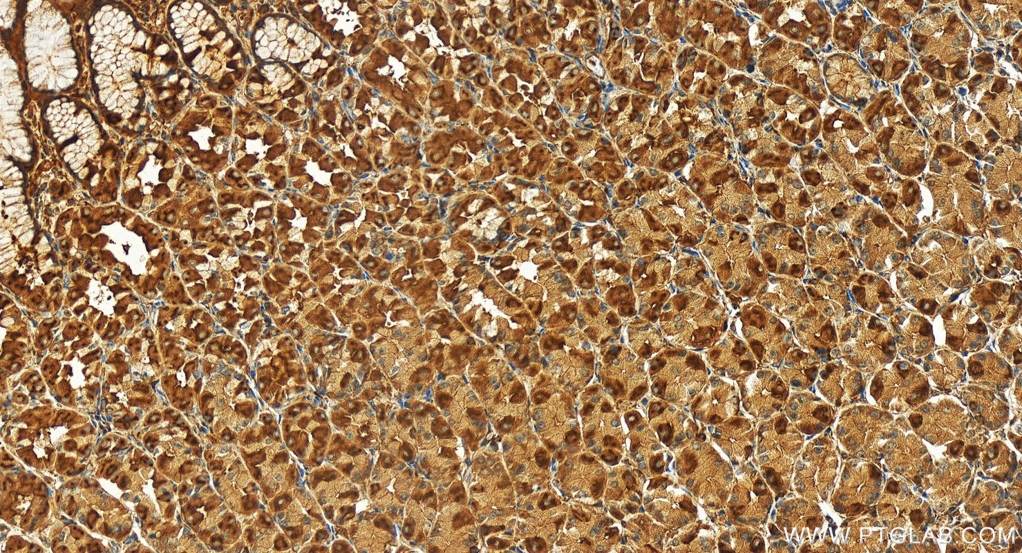 Immunohistochemistry (IHC) staining of human stomach cancer tissue using EHD1 Polyclonal antibody (24657-1-AP)
