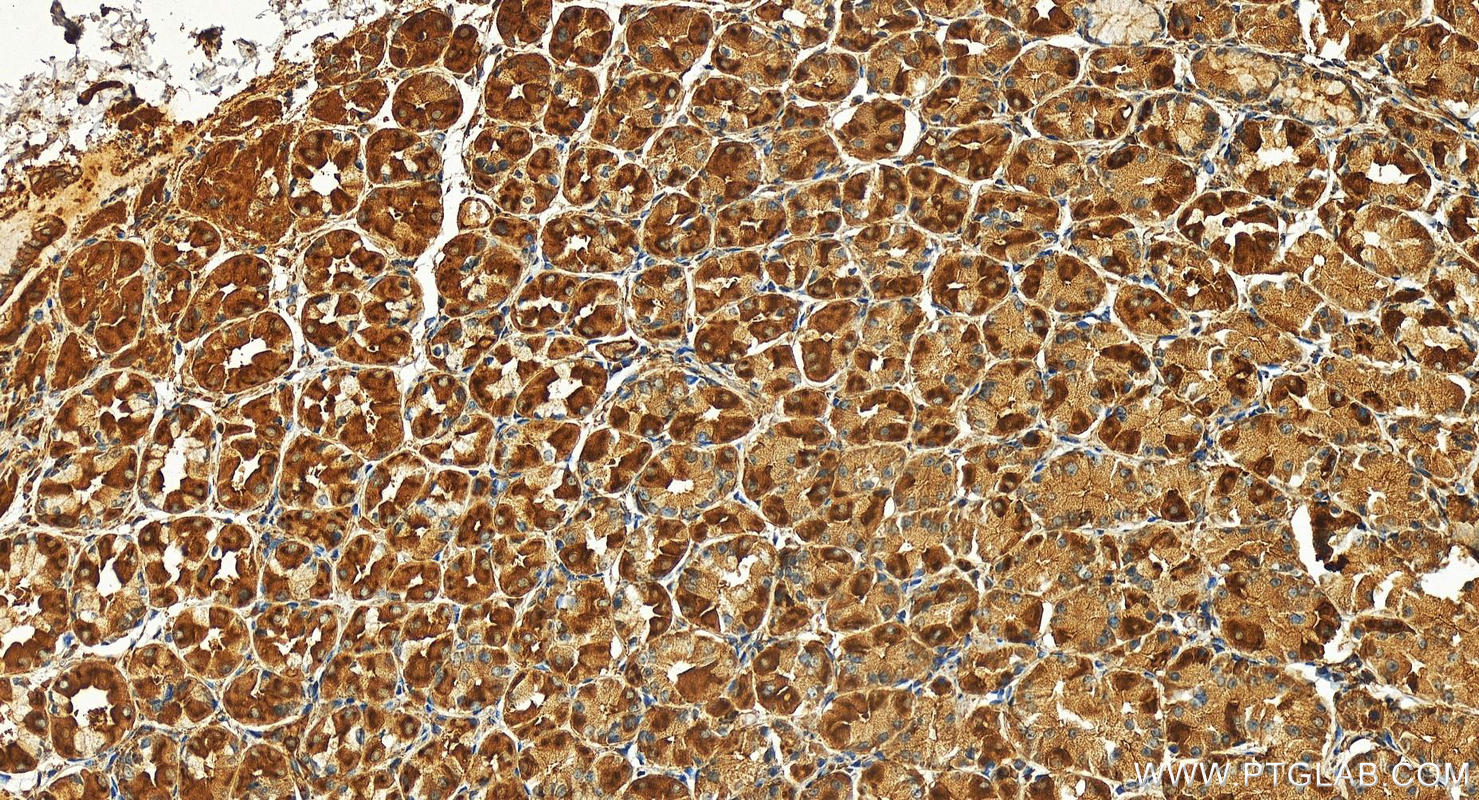Immunohistochemistry (IHC) staining of human stomach cancer tissue using EHD1 Polyclonal antibody (24657-1-AP)