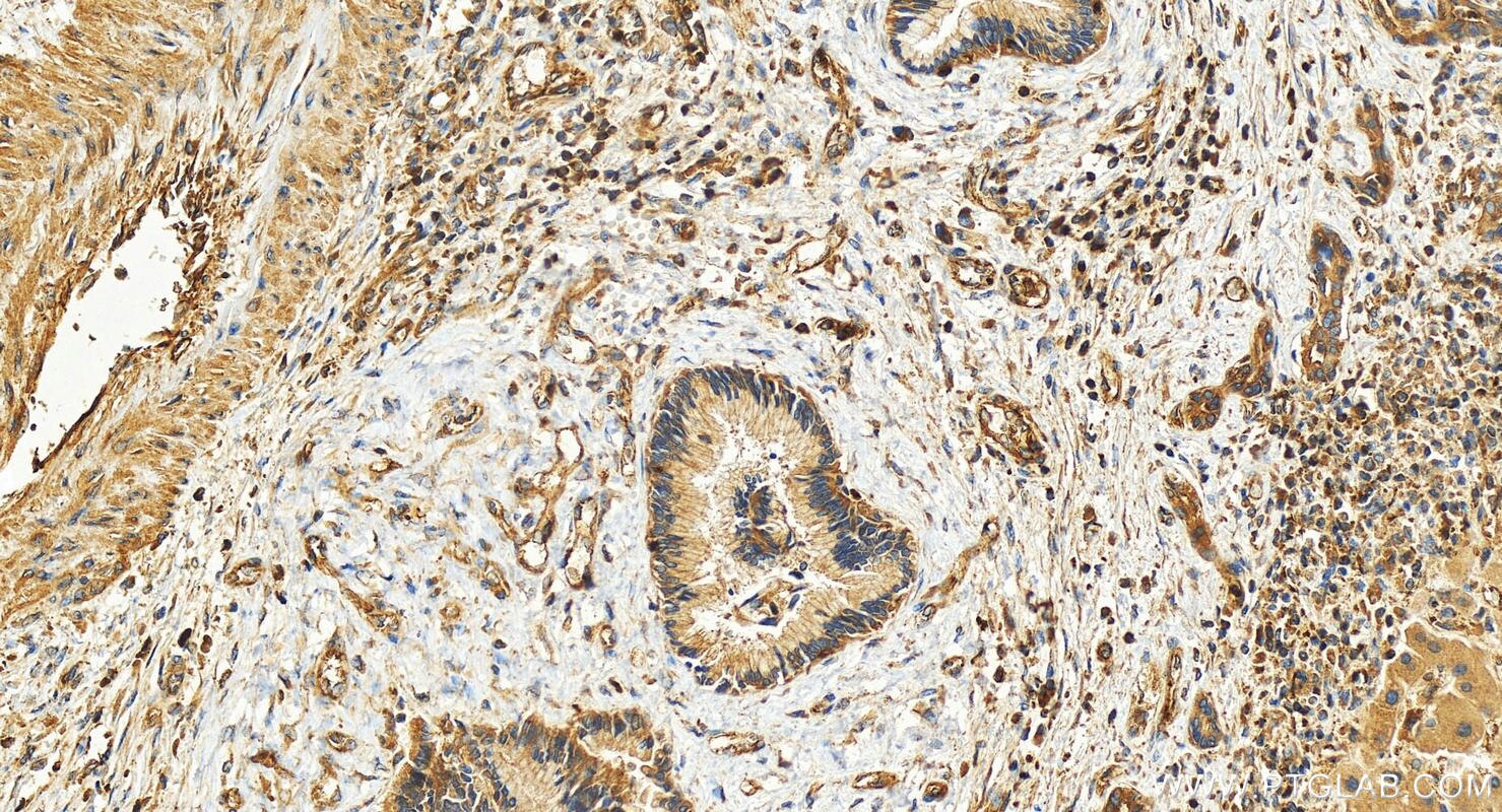 Immunohistochemistry (IHC) staining of human intrahepatic cholangiocarcinoma tissue using EHD1 Polyclonal antibody (24657-1-AP)