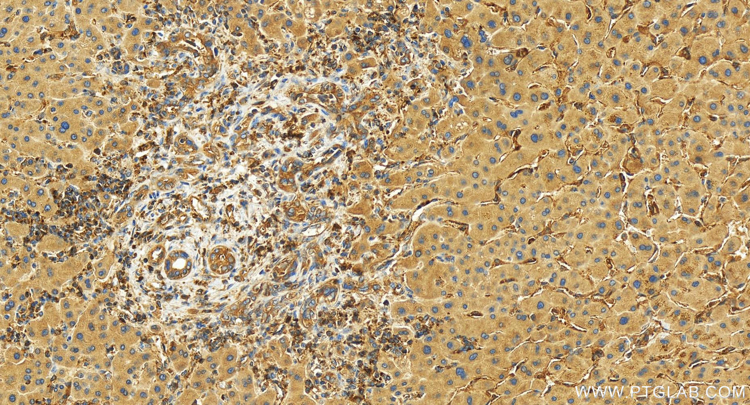 Immunohistochemistry (IHC) staining of human intrahepatic cholangiocarcinoma tissue using EHD1 Polyclonal antibody (24657-1-AP)