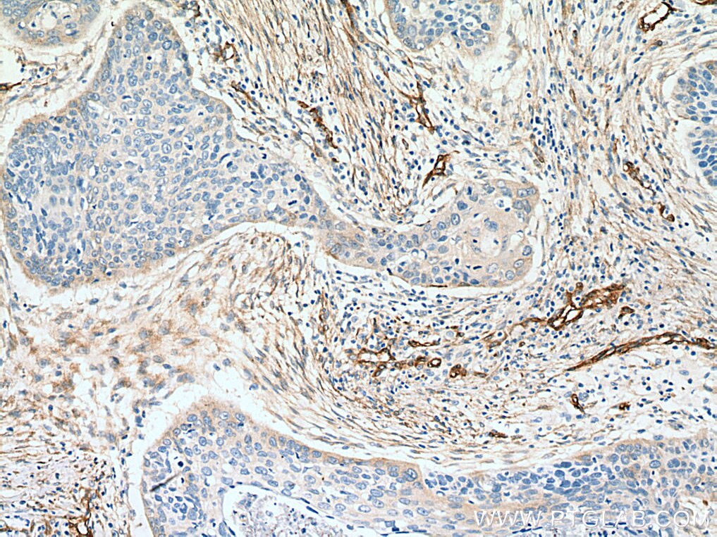 Immunohistochemistry (IHC) staining of human oesophagus cancer tissue using EHD2 Polyclonal antibody (11440-1-AP)