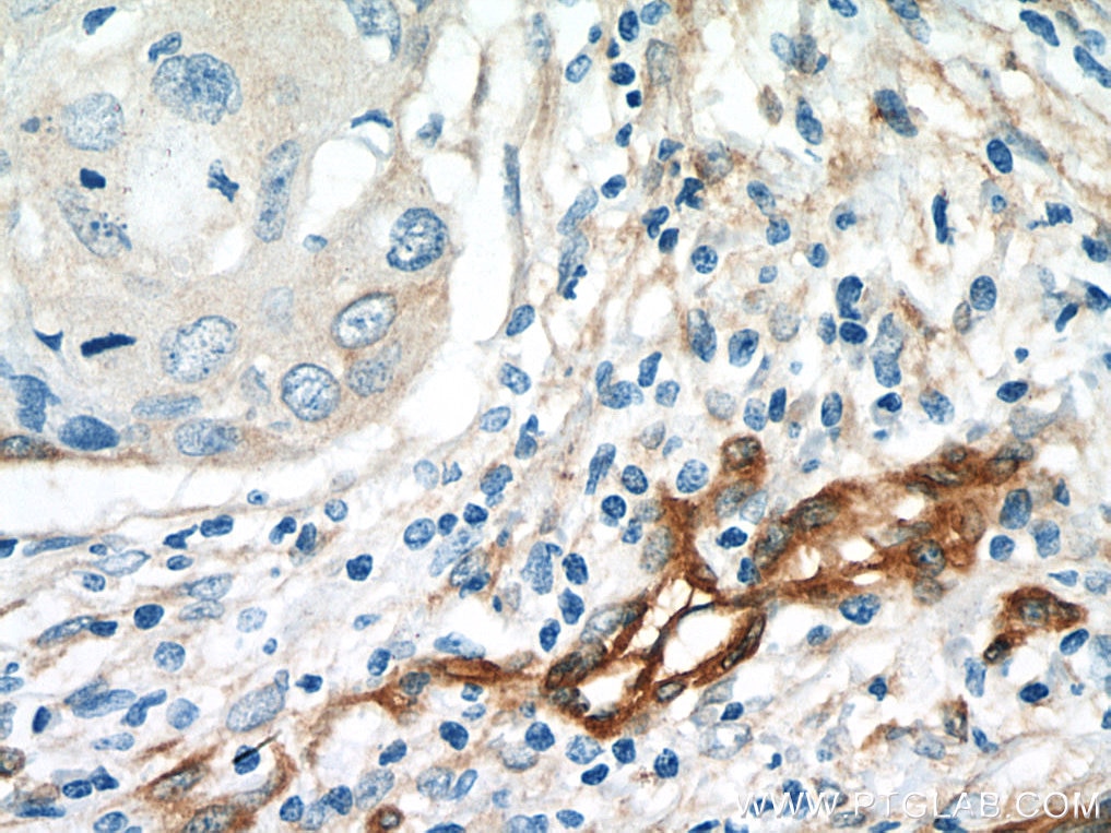 Immunohistochemistry (IHC) staining of human oesophagus cancer tissue using EHD2 Polyclonal antibody (11440-1-AP)