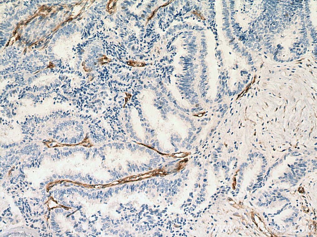 IHC staining of human ovary tumor using 11440-1-AP