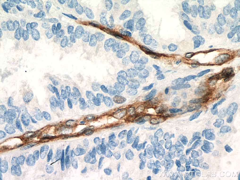Immunohistochemistry (IHC) staining of human ovary tumor tissue using EHD2 Polyclonal antibody (11440-1-AP)