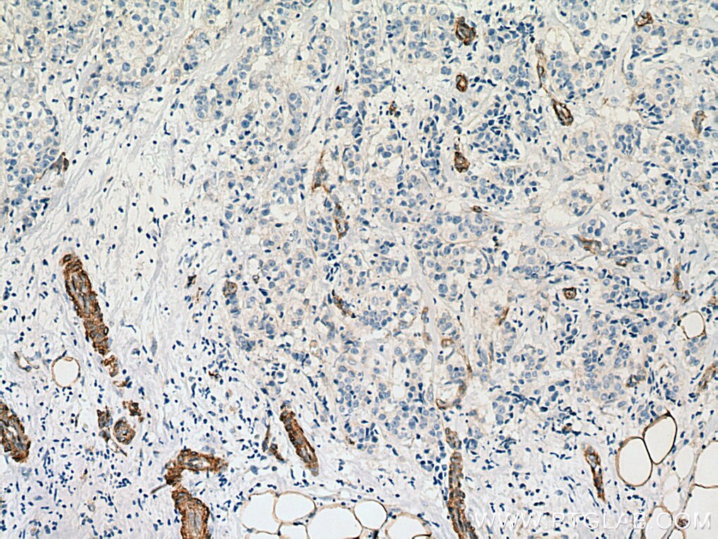 Immunohistochemistry (IHC) staining of human breast cancer tissue using EHD2 Polyclonal antibody (11440-1-AP)