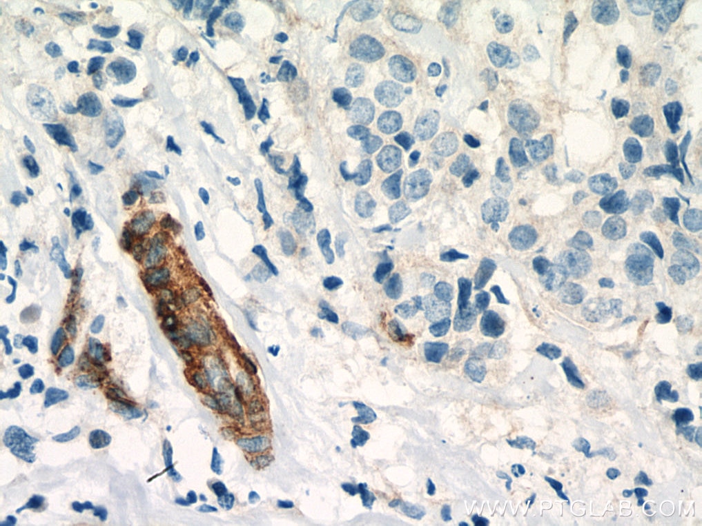 Immunohistochemistry (IHC) staining of human breast cancer tissue using EHD2 Polyclonal antibody (11440-1-AP)