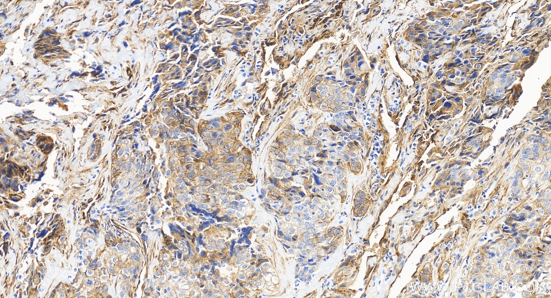 Immunohistochemistry (IHC) staining of human ovary cancer tissue using EHD2 Recombinant monoclonal antibody (85604-4-RR)