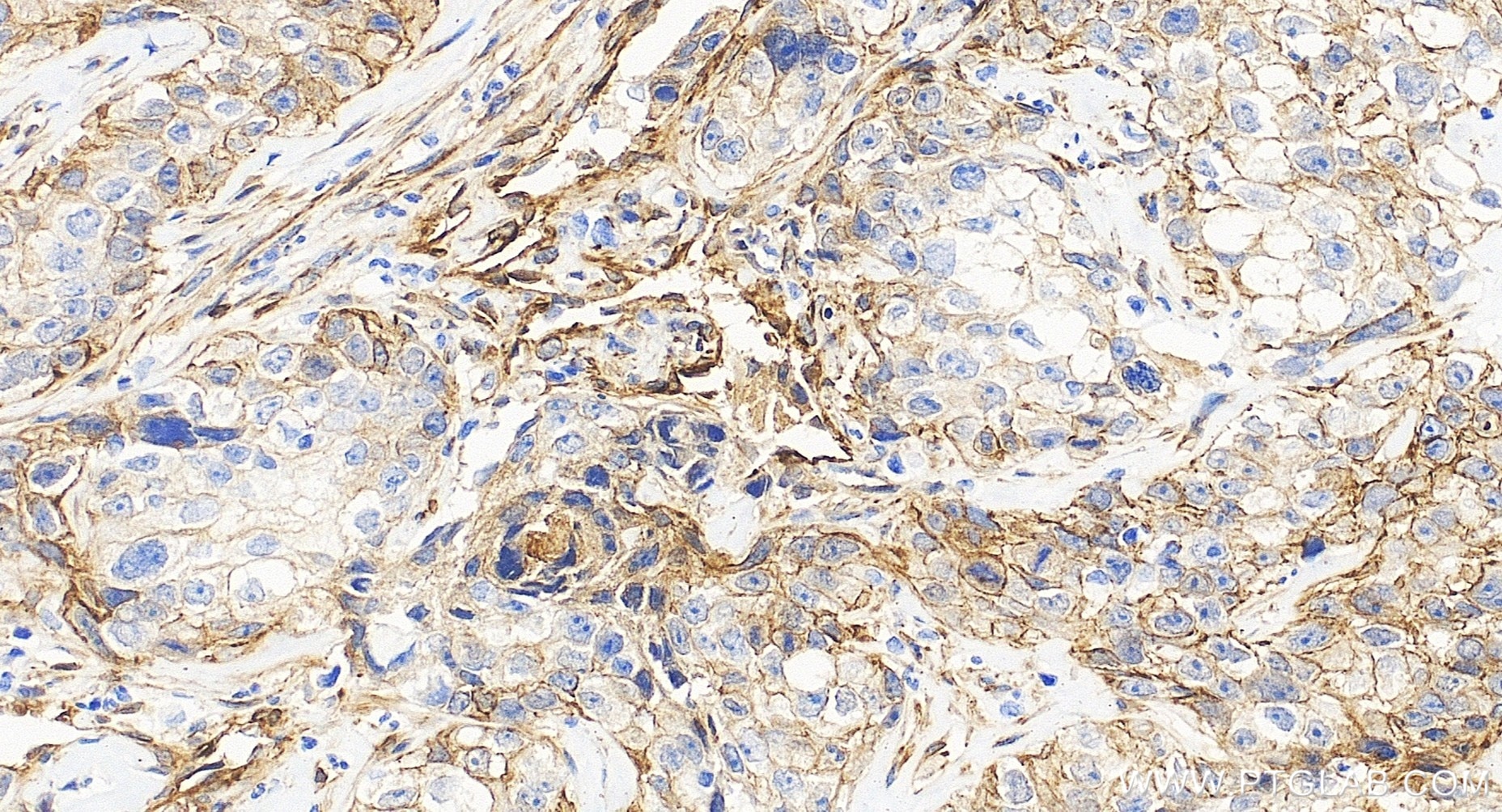 Immunohistochemistry (IHC) staining of human ovary cancer tissue using EHD2 Recombinant monoclonal antibody (85604-4-RR)