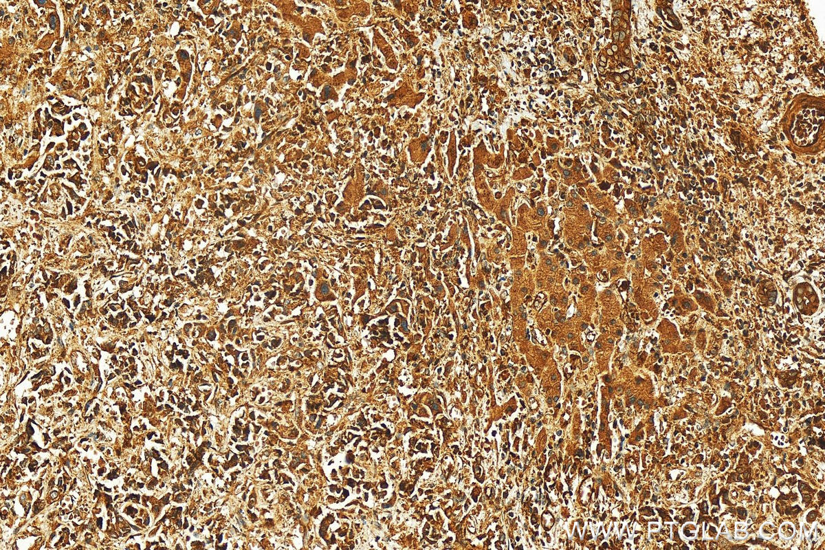 Immunohistochemistry (IHC) staining of human intrahepatic cholangiocarcinoma tissue using EHD4 Polyclonal antibody (11382-2-AP)