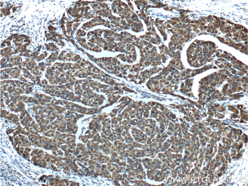 Immunohistochemistry (IHC) staining of human liver cancer tissue using EHHADH Polyclonal antibody (26570-1-AP)