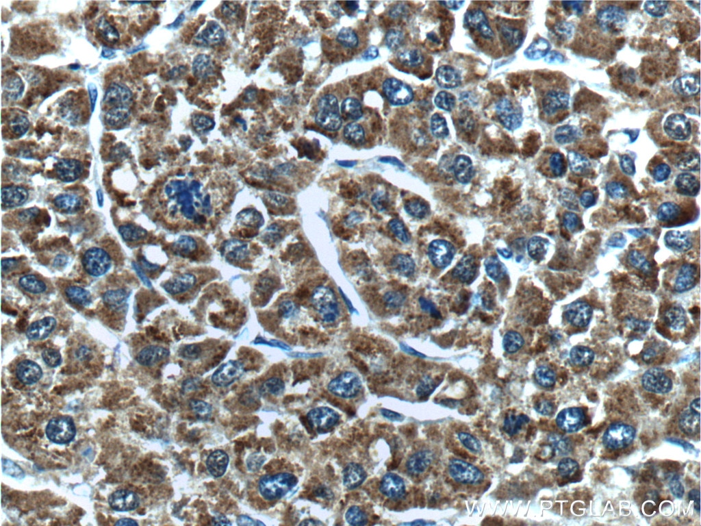 Immunohistochemistry (IHC) staining of human liver cancer tissue using EHHADH Polyclonal antibody (26570-1-AP)