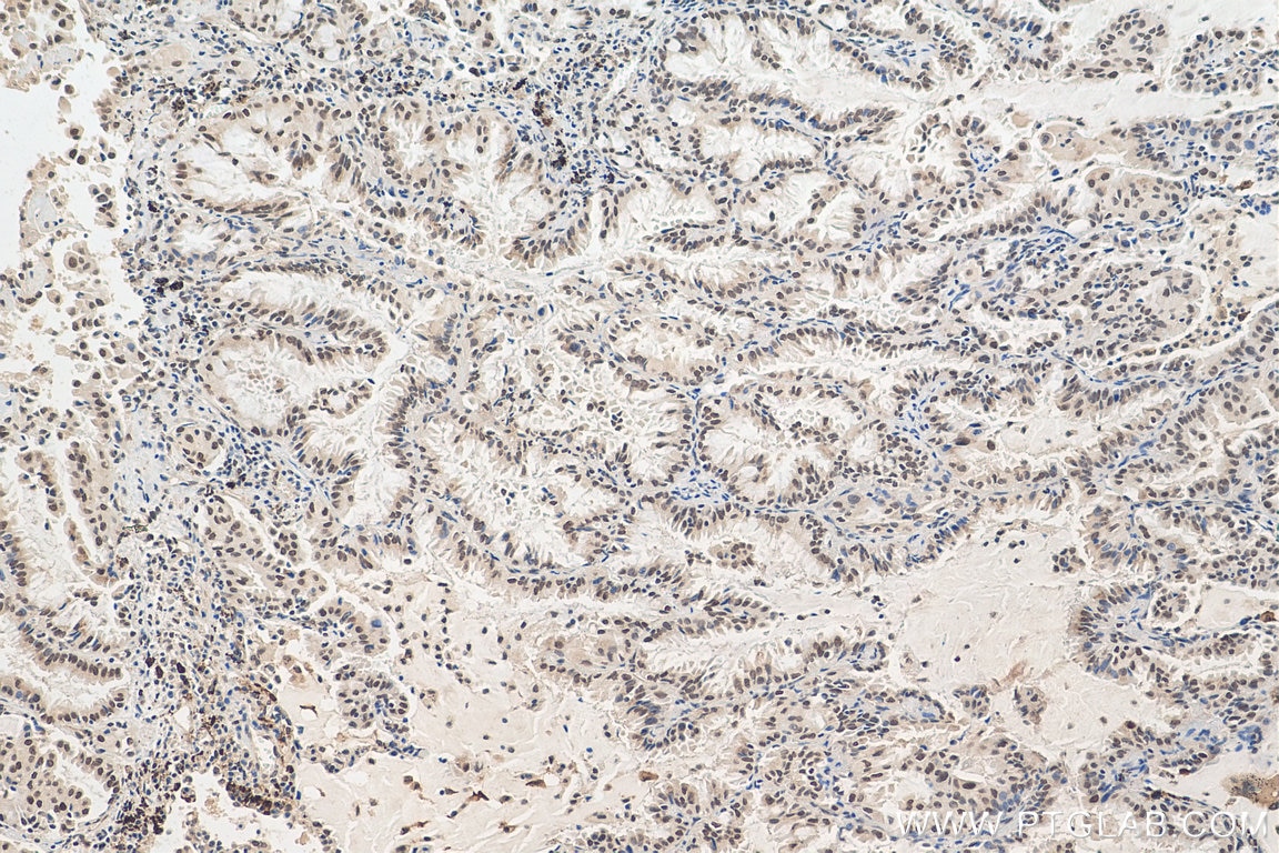 Immunohistochemistry (IHC) staining of human lung cancer tissue using EHMT2 Polyclonal antibody (29303-1-AP)