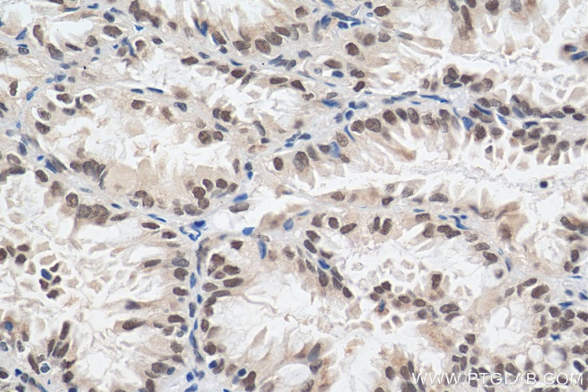 IHC staining of human lung cancer using 29303-1-AP