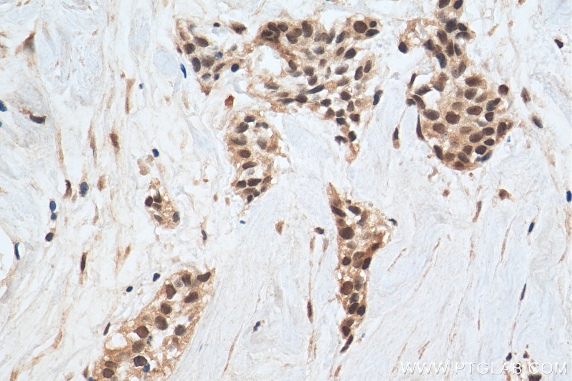 Immunohistochemistry (IHC) staining of human urothelial carcinoma tissue using EHMT2 Polyclonal antibody (29303-1-AP)