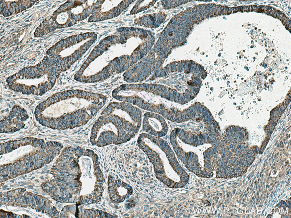 Immunohistochemistry (IHC) staining of human colon cancer tissue using EI24 Polyclonal antibody (20456-1-AP)