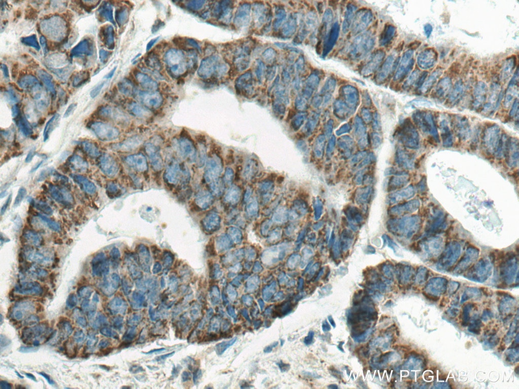 Immunohistochemistry (IHC) staining of human colon cancer tissue using EI24 Polyclonal antibody (20456-1-AP)