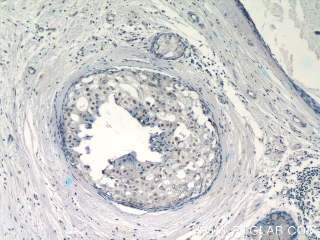 Immunohistochemistry (IHC) staining of human breast cancer tissue using EID1 Polyclonal antibody (11734-1-AP)