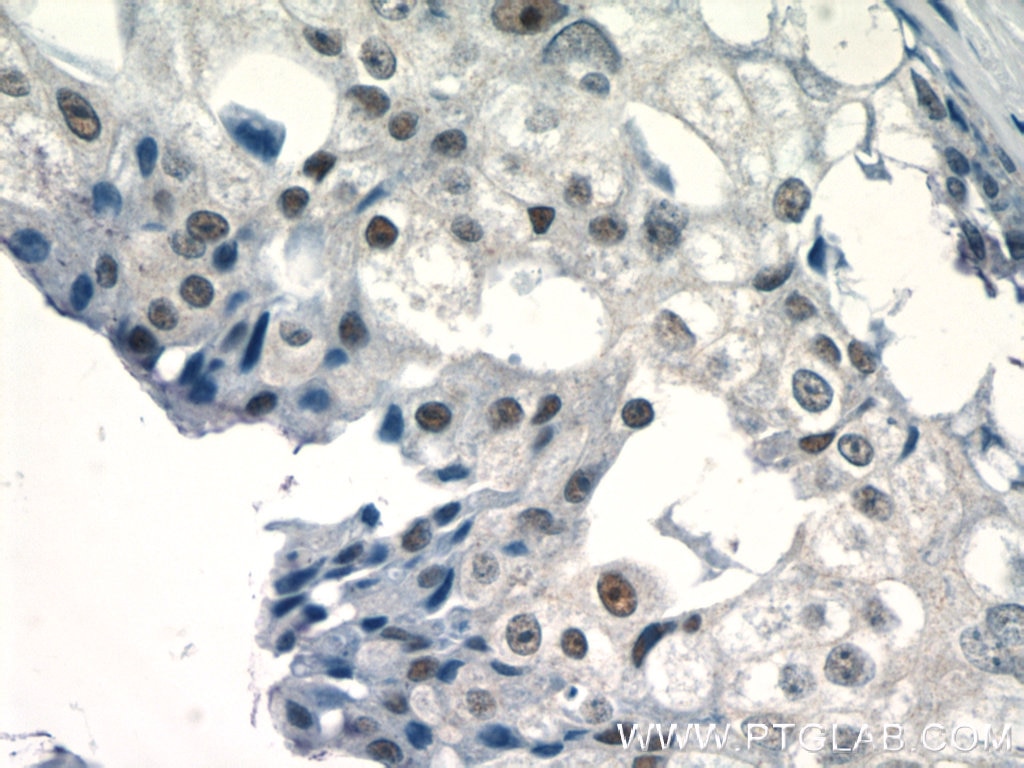 Immunohistochemistry (IHC) staining of human breast cancer tissue using EID1 Polyclonal antibody (11734-1-AP)