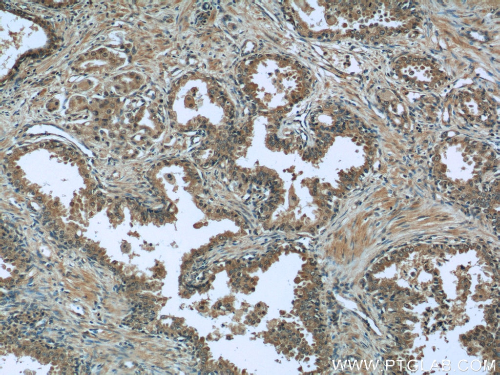 Immunohistochemistry (IHC) staining of human prostate cancer tissue using EIF1 Polyclonal antibody (15276-1-AP)