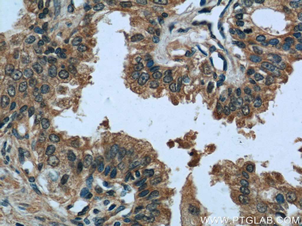 Immunohistochemistry (IHC) staining of human prostate cancer tissue using EIF1 Polyclonal antibody (15276-1-AP)