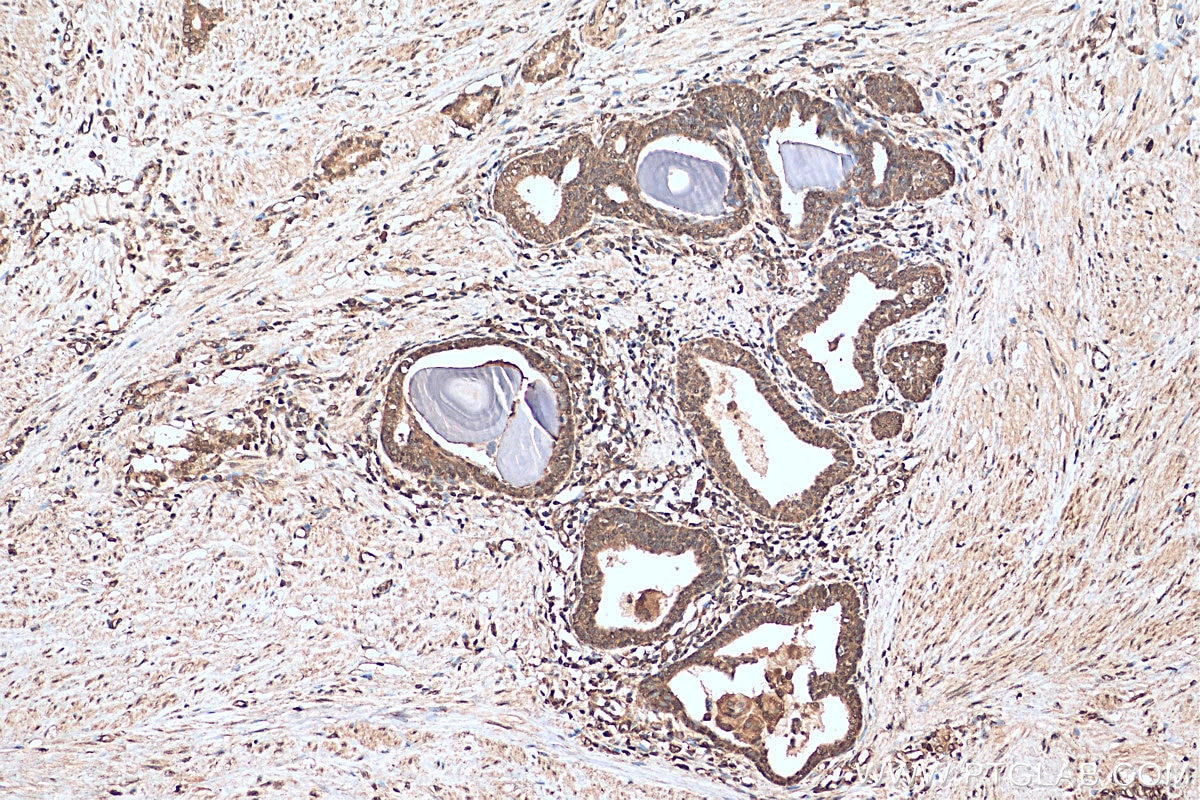 IHC staining of human prostate cancer using 15276-1-AP