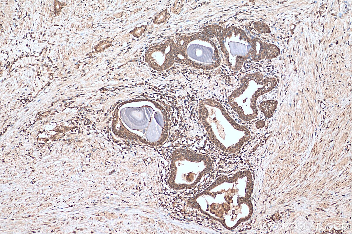 Immunohistochemistry (IHC) staining of human prostate cancer tissue using EIF1 Polyclonal antibody (15276-1-AP)