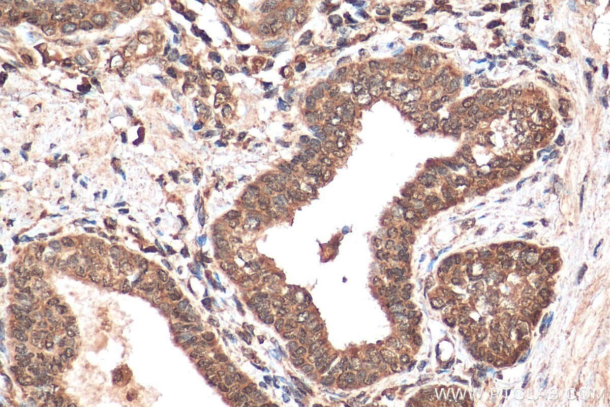 IHC staining of human prostate cancer using 15276-1-AP