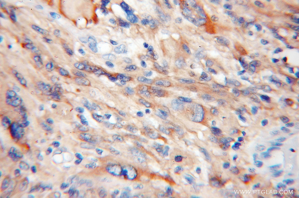 Immunohistochemistry (IHC) staining of human gliomas tissue using EIF1AX Polyclonal antibody (11649-2-AP)