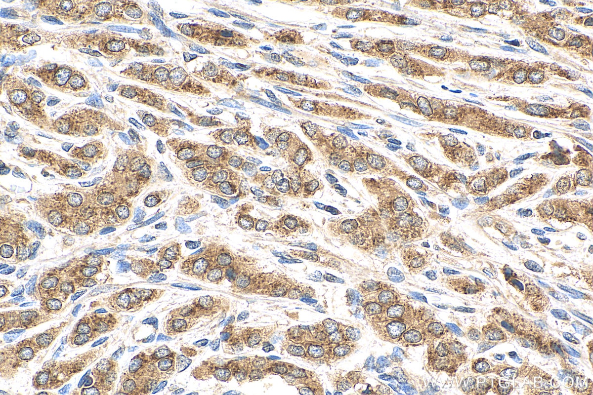 Immunohistochemistry (IHC) staining of human prostate cancer tissue using EIF2A/CDA02 Polyclonal antibody (11233-1-AP)