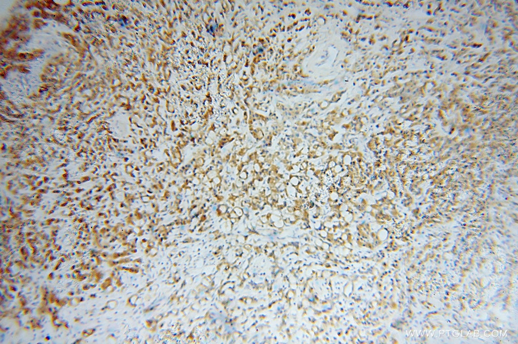 Immunohistochemistry (IHC) staining of human prostate cancer tissue using EIF2A/CDA02 Polyclonal antibody (11233-1-AP)