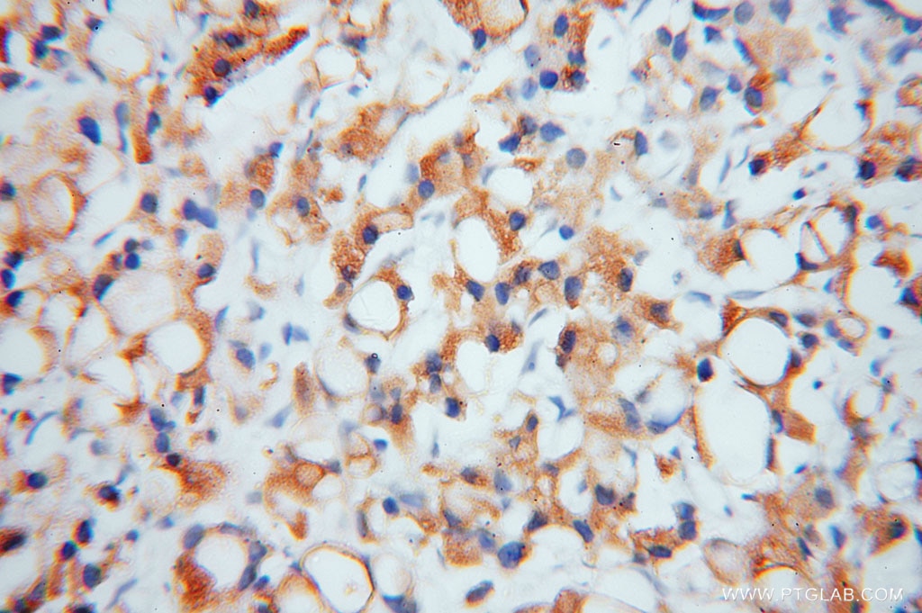 Immunohistochemistry (IHC) staining of human prostate cancer tissue using EIF2A/CDA02 Polyclonal antibody (11233-1-AP)