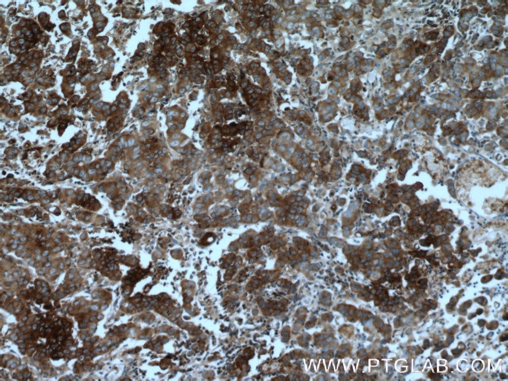 Immunohistochemistry (IHC) staining of human prostate cancer tissue using EIF2A/CDA02 Monoclonal antibody (66482-1-Ig)