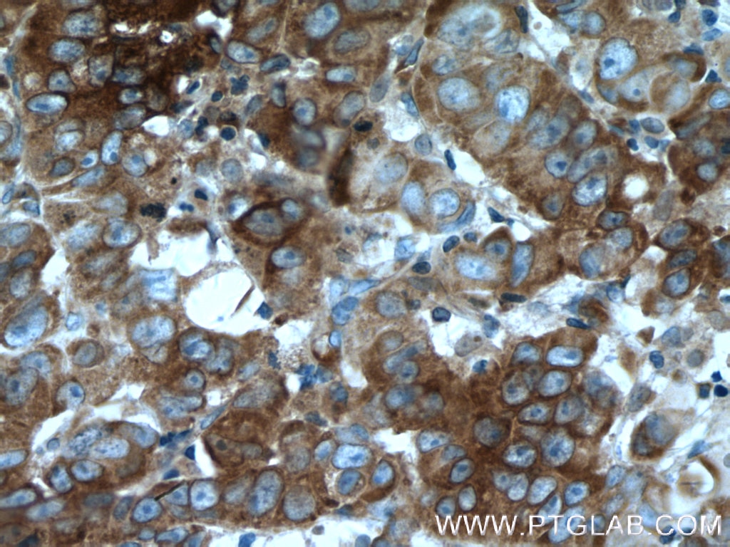 Immunohistochemistry (IHC) staining of human prostate cancer tissue using EIF2A/CDA02 Monoclonal antibody (66482-1-Ig)