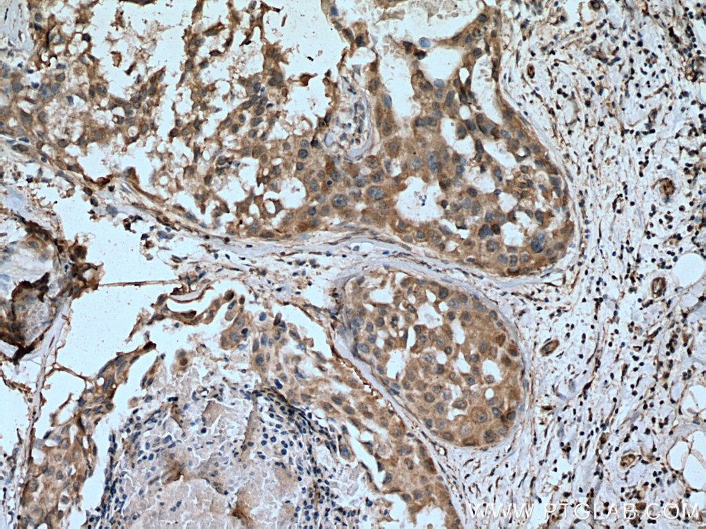 IHC staining of human breast cancer using 20499-1-AP