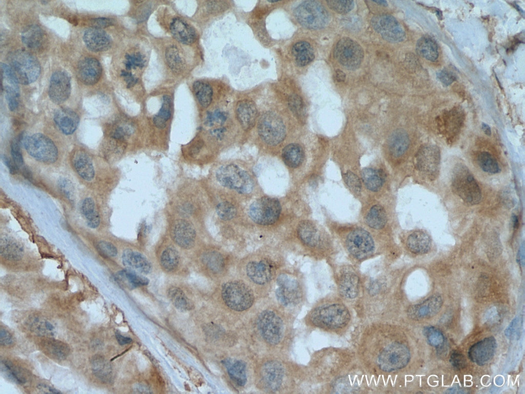 Immunohistochemistry (IHC) staining of human breast cancer tissue using EIF2AK1 Polyclonal antibody (20499-1-AP)