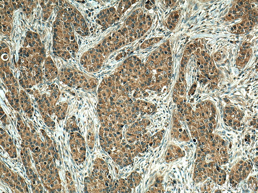 Immunohistochemistry (IHC) staining of human breast cancer tissue using EIF2AK1 Monoclonal antibody (67674-1-Ig)