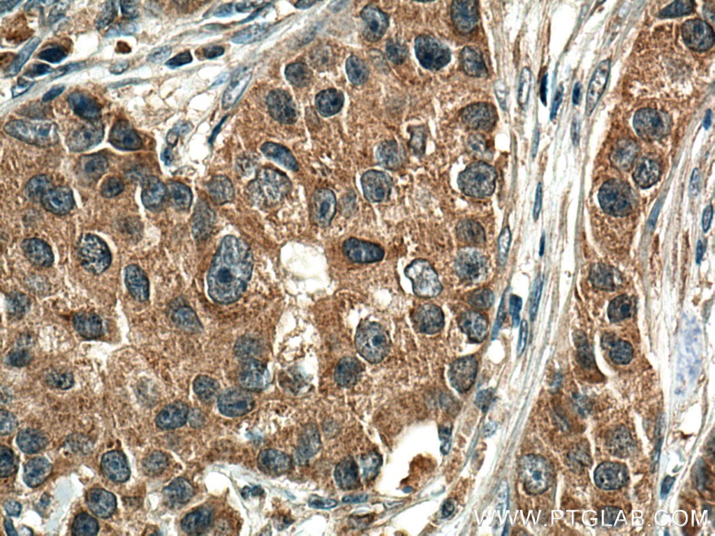 Immunohistochemistry (IHC) staining of human breast cancer tissue using EIF2AK1 Monoclonal antibody (67674-1-Ig)