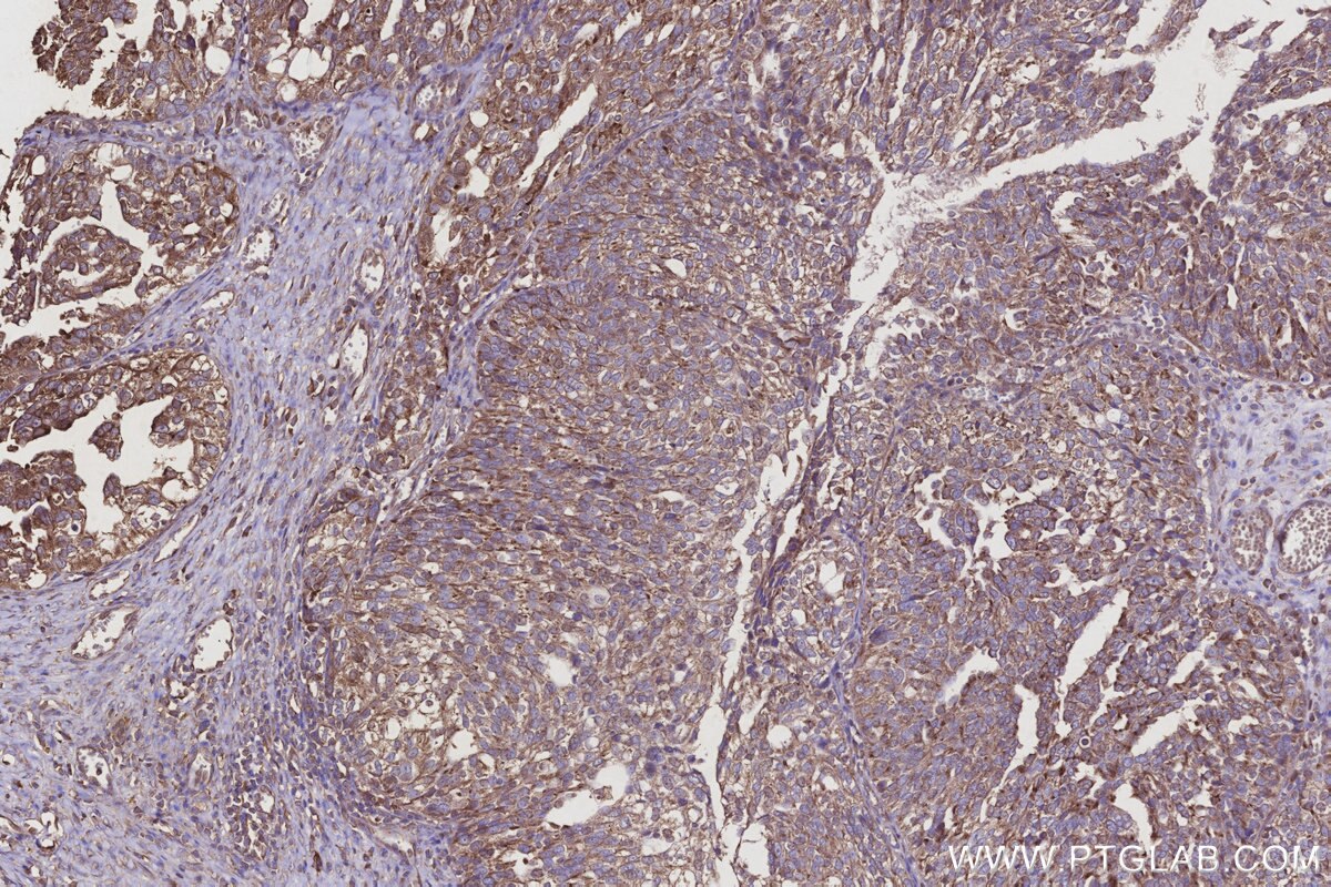 Immunohistochemistry (IHC) staining of human ovary cancer tissue using EIF2AK1 Monoclonal antibody (67674-1-Ig)