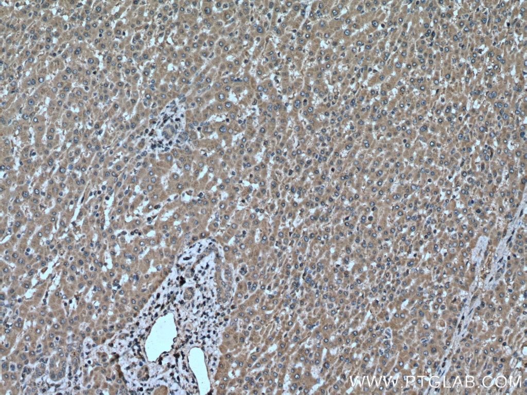 IHC staining of human liver cancer using 24390-1-AP