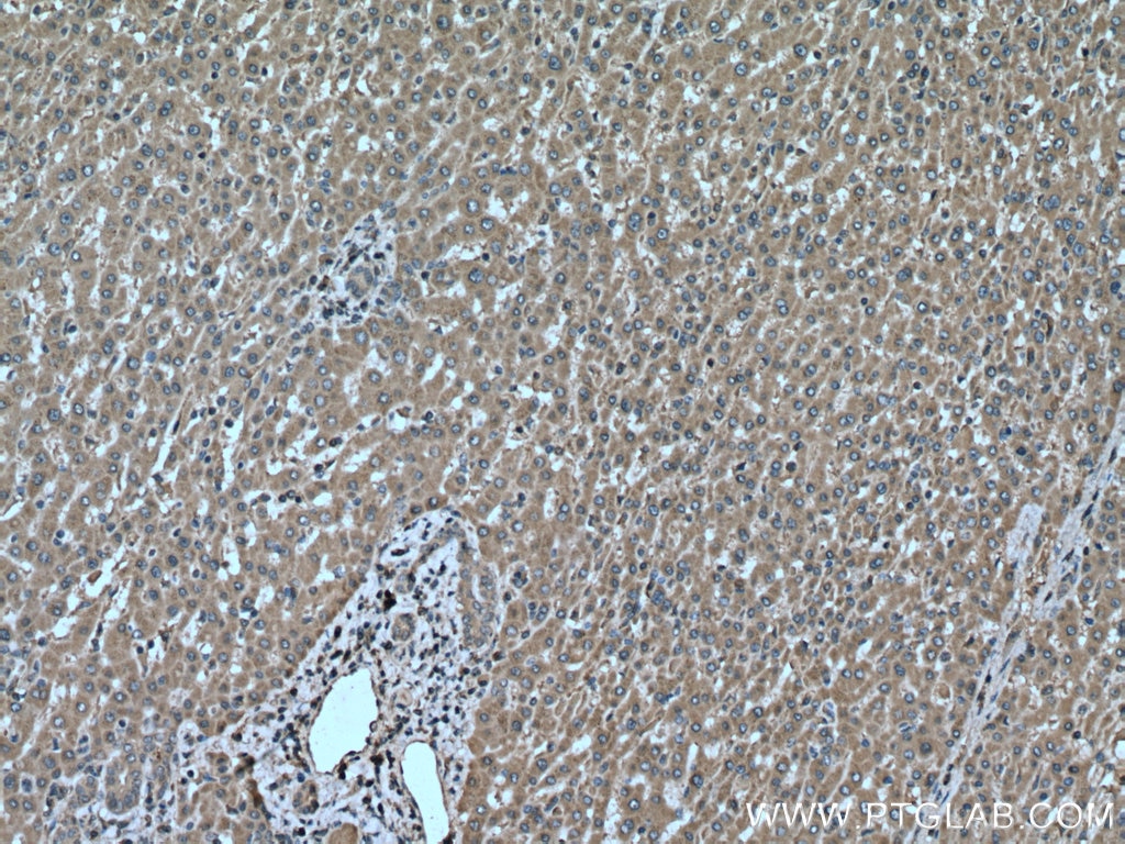 Immunohistochemistry (IHC) staining of human liver cancer tissue using PERK/EIF2AK3 Polyclonal antibody (24390-1-AP)