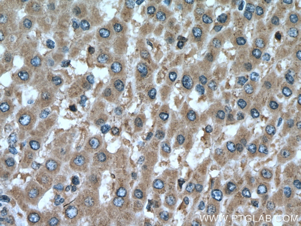 Immunohistochemistry (IHC) staining of human liver cancer tissue using PERK/EIF2AK3 Polyclonal antibody (24390-1-AP)