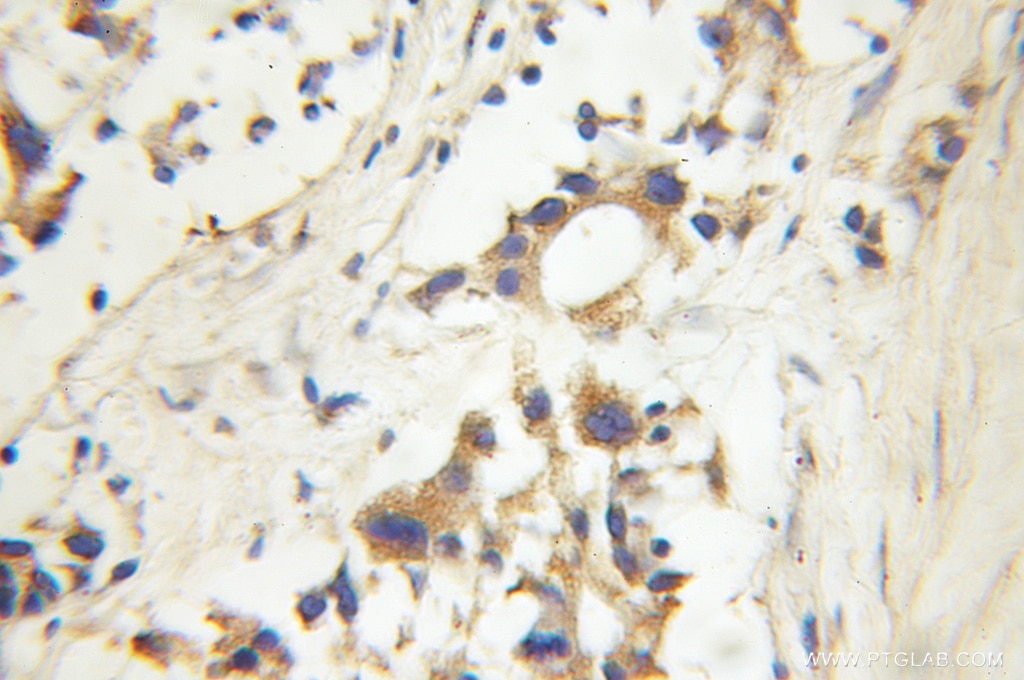 Immunohistochemistry (IHC) staining of human prostate cancer tissue using EIF2AK4 Polyclonal antibody (11174-1-AP)