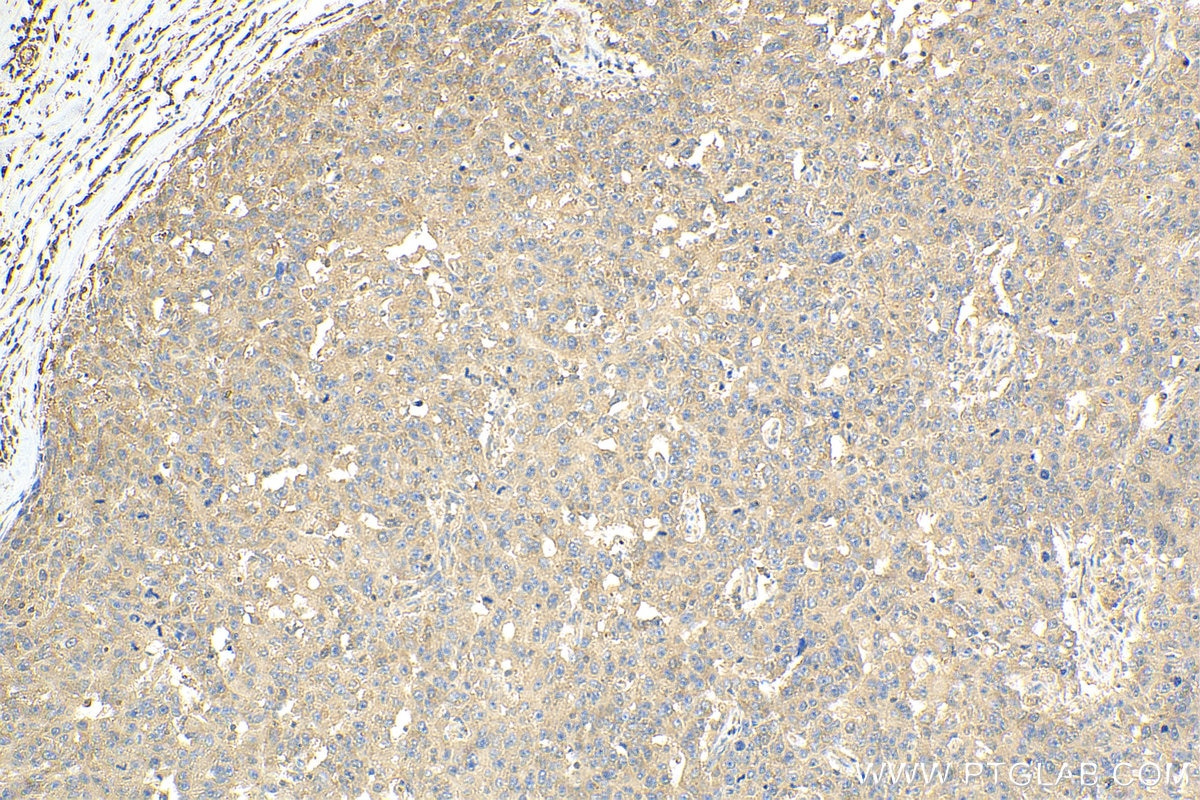 IHC staining of human breast cancer using 18010-1-AP