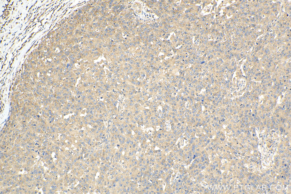 Immunohistochemistry (IHC) staining of human breast cancer tissue using EIF2B1 Polyclonal antibody (18010-1-AP)