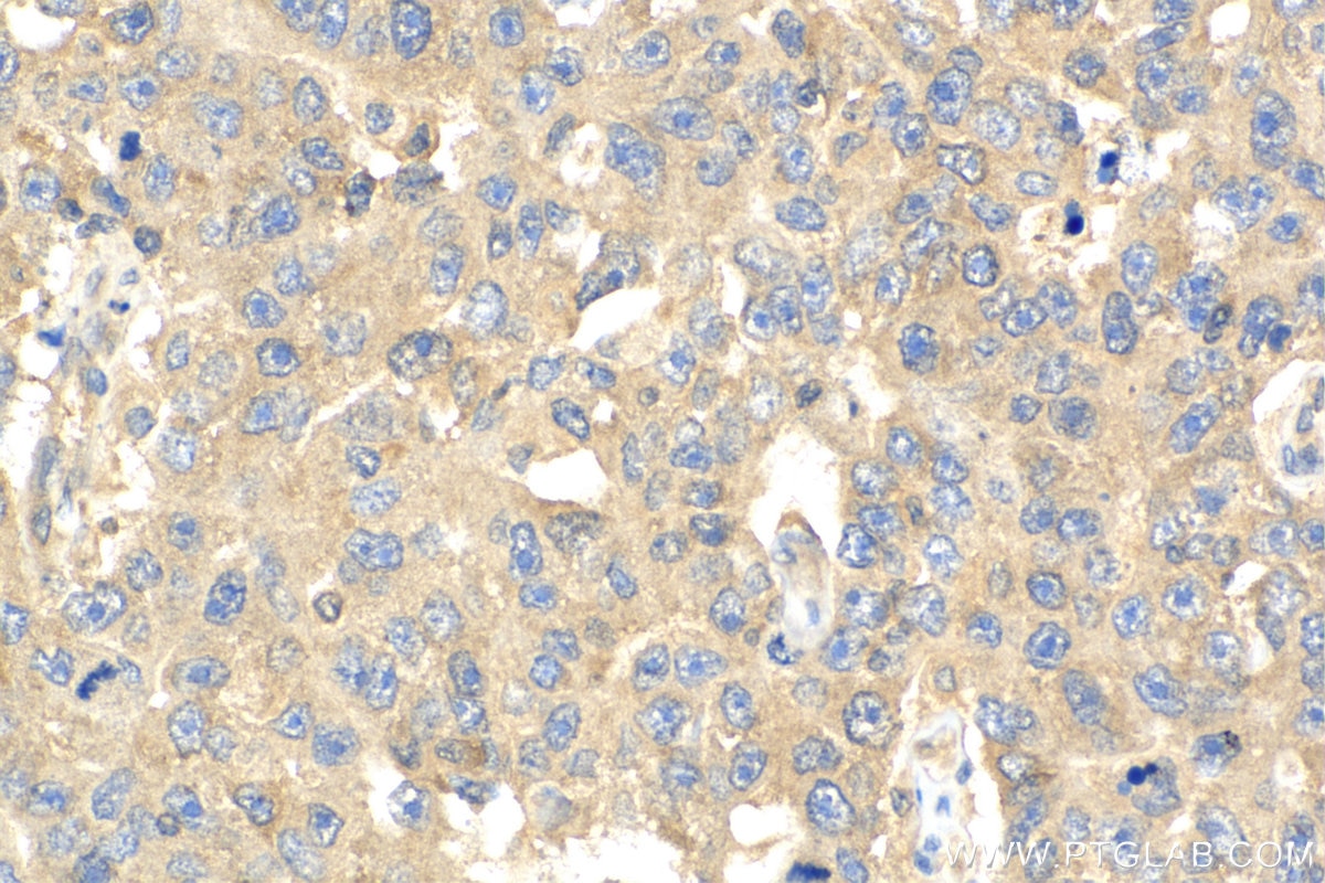 Immunohistochemistry (IHC) staining of human breast cancer tissue using EIF2B1 Polyclonal antibody (18010-1-AP)