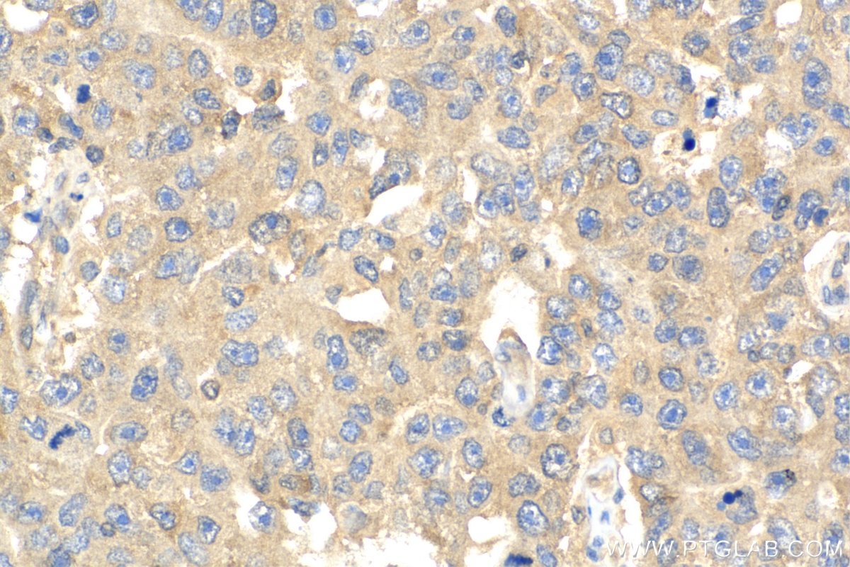 IHC staining of human breast cancer using 18010-1-AP