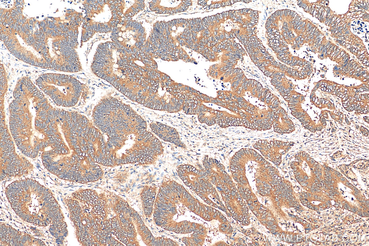 Immunohistochemistry (IHC) staining of human colon cancer tissue using EIF2B5 Polyclonal antibody (29935-1-AP)